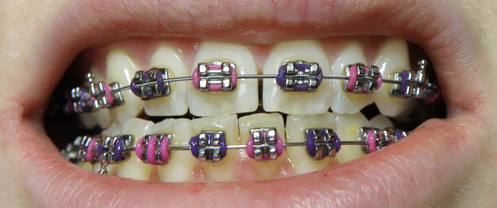 Appareil orthodontique fixe sur les deux machoires montrant des brackets metalliques