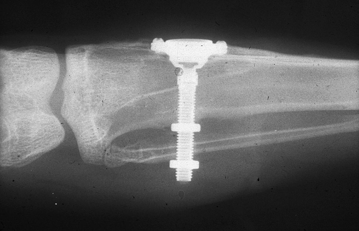 Radiographie d'un implant dentaire montrant l'integration dans l'os de la machoire